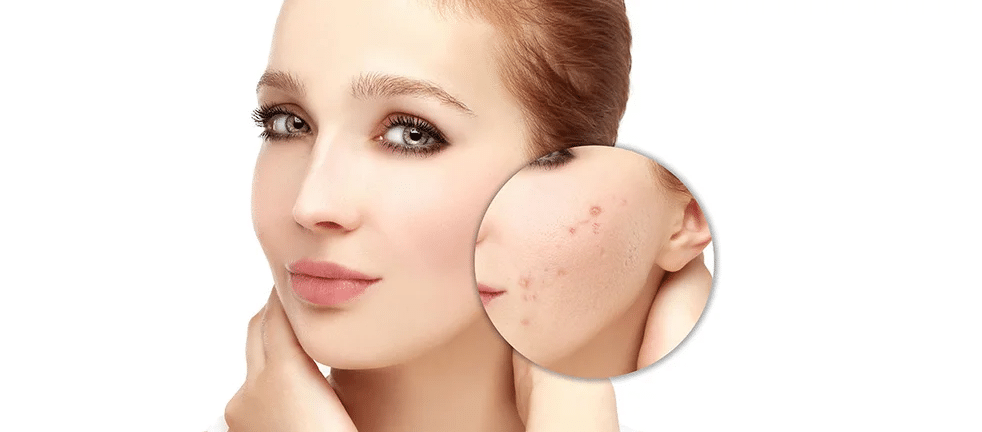 Удаление постакне