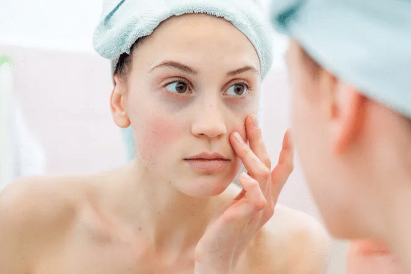 Как убрать синяки под глазами