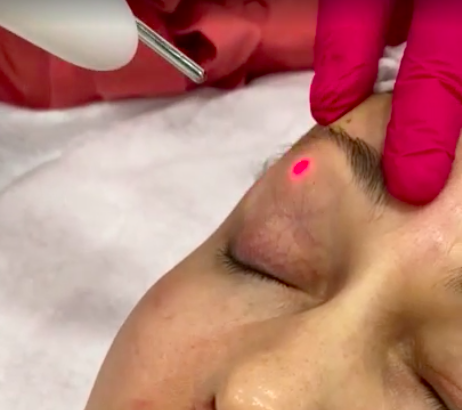 Лазерное омоложение век