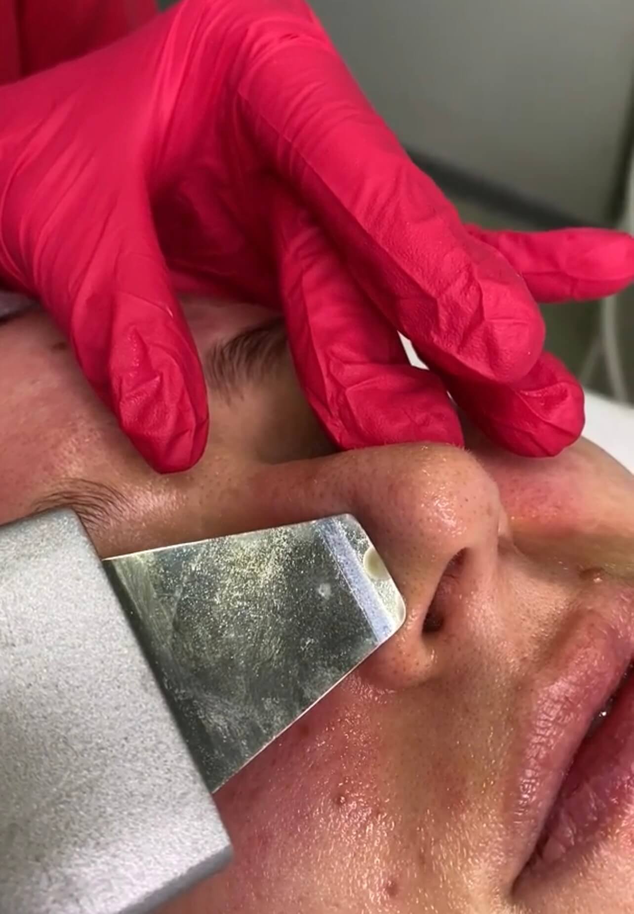 Ультразвуковая чистка лица