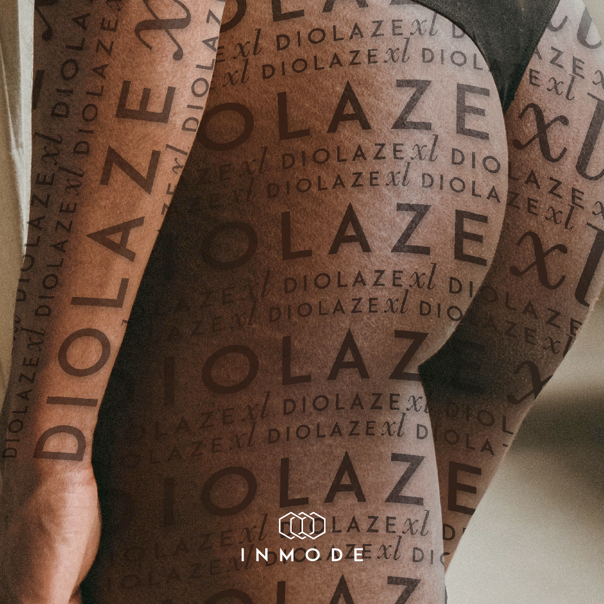 Лазерная эпиляция зоны глубокого бикини