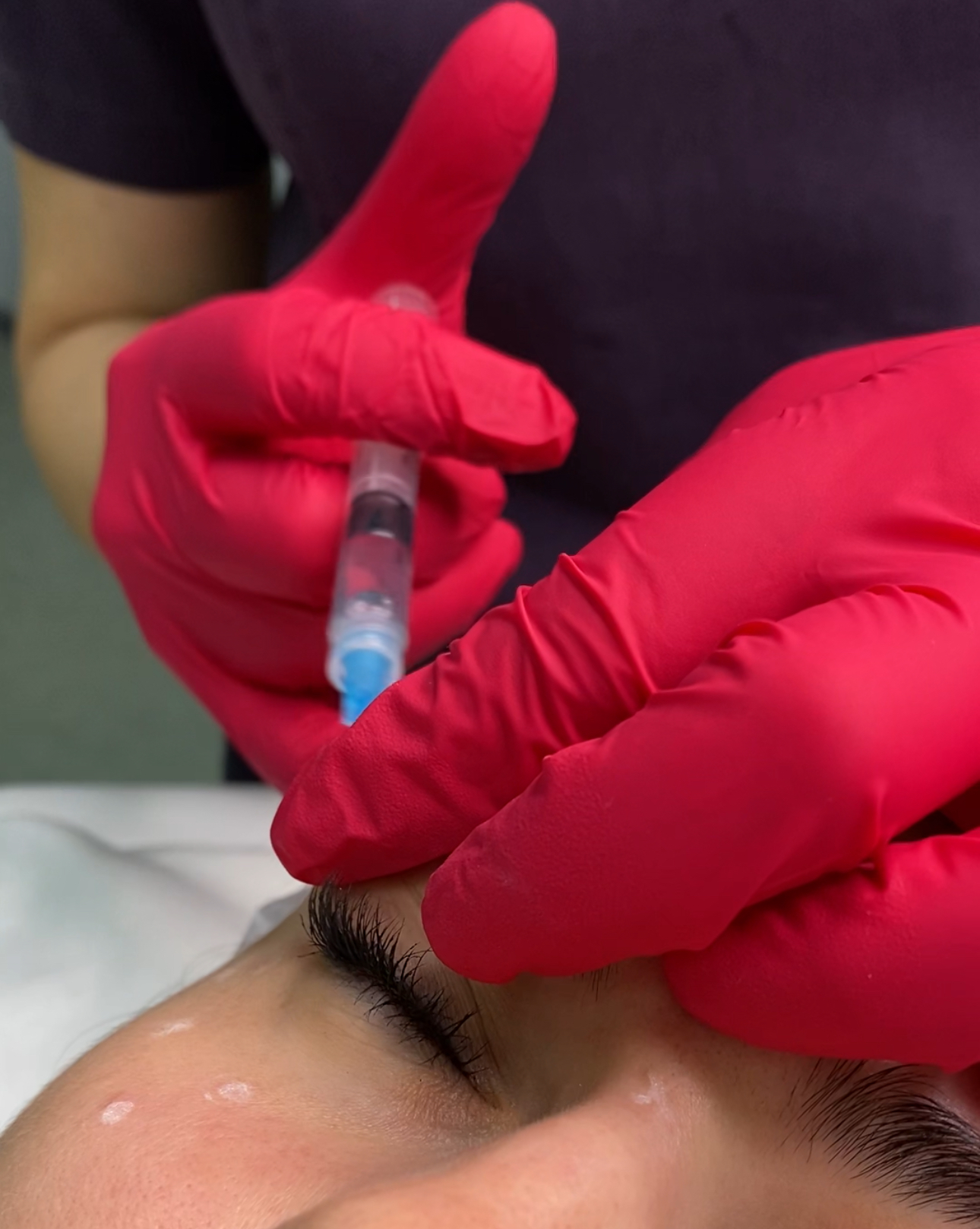 Мезотерапия кожи вокруг глаз