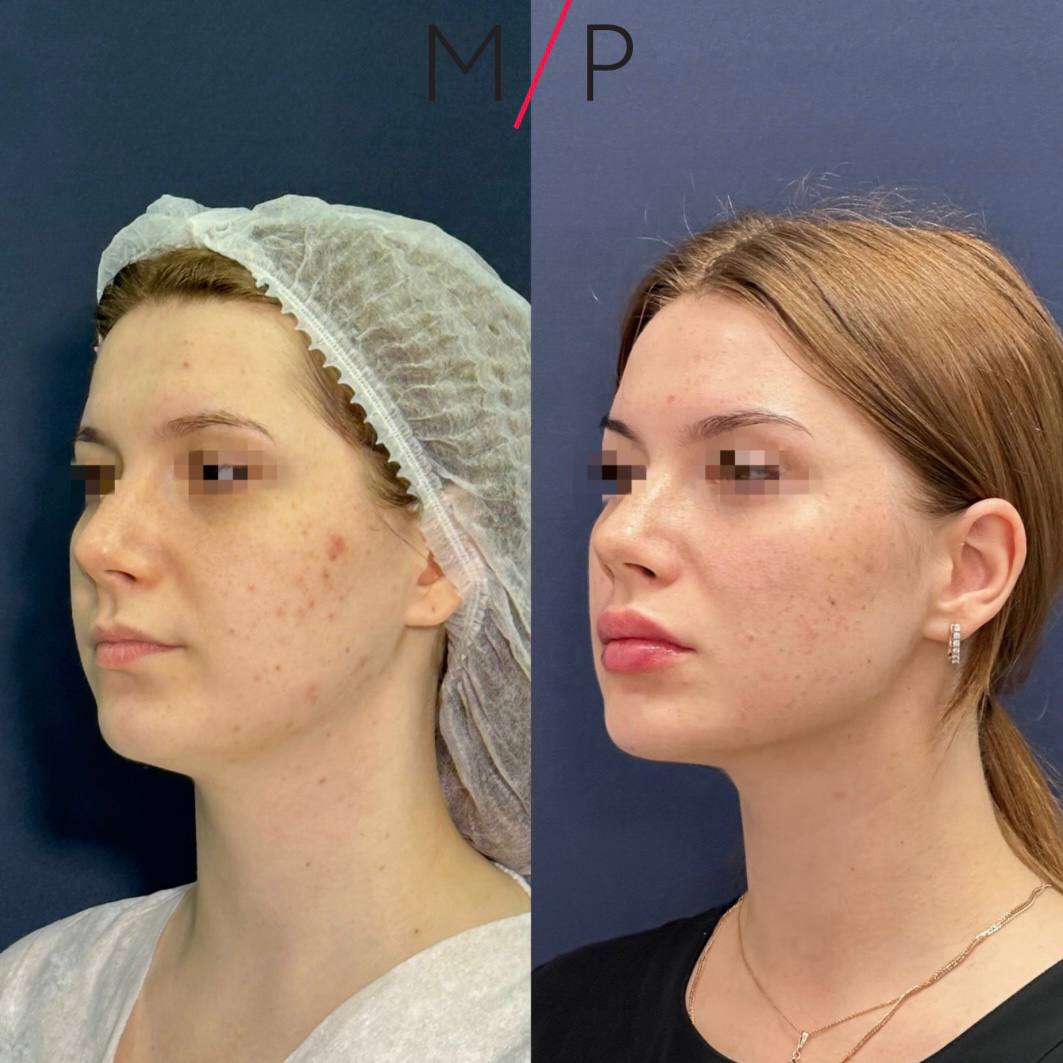 Волюмизация лица