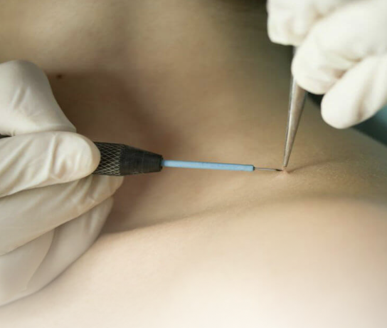 Удаление папиллом лазером